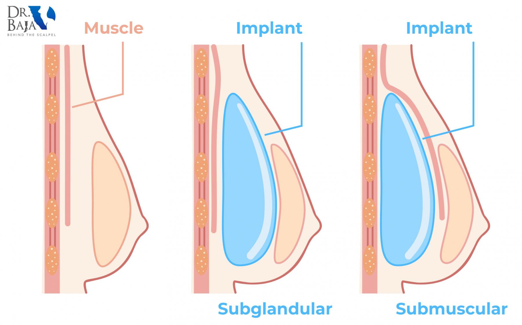 Implant placement